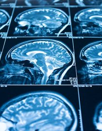 ADHD Brain Scan: How Brain Scans May Change the ADHD Diagnoses